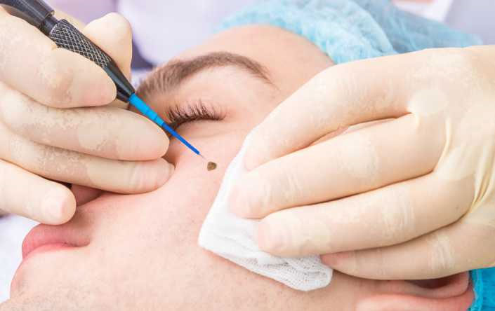 Dermatological Cryosurgery